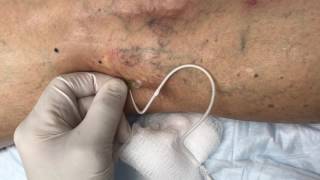 Treating Reticular Veins with Foam Sclerotherapy [upl. by Rebmaed]