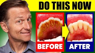 Natural Solution for Plaque Cavities and Gingivitis [upl. by Salas]