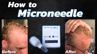 How to Microneedle for Hair Loss Using the Derminator 2 [upl. by Vania]