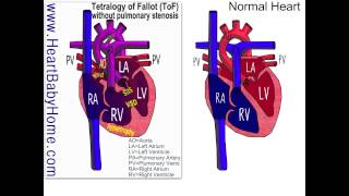 41 Tetralogy of Fallot withOUT pulmonary stenosis [upl. by Ruttger25]