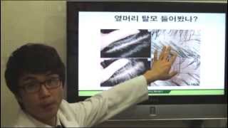 옆머리탈모 원인과 hairloss  alopecia  탈모치료법 [upl. by Aisyle]