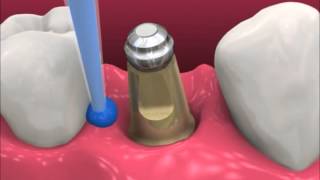 Smyl Manatee  Dental Implant Procedure [upl. by Adamsun]