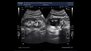 Ultrasound Video showing renal Angiomyolipoma with stones at PUJ [upl. by Yusem]