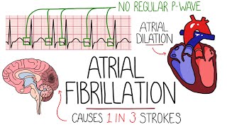 Atrial Fibrillation Made Easy Complete Overview [upl. by Oiril]