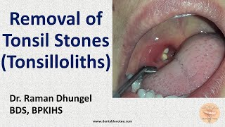 Tonsil Stone Removal  Tonsillolith removal by Dr Raman Dhungel [upl. by Laws111]