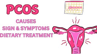 Polycystic Ovary Syndrome  PCOS  Causes  Sign  Symptoms amp Dietary Treatment [upl. by Eicyac812]