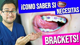 ¡COMO saber si necesito BRACKETS 👅 GUÍA PRACTICA 2019 😎 ORTODONCIA [upl. by Koorb569]