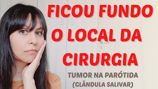 quotAfundamentoquot do rosto  tumor na parótida glândula salivar [upl. by Treblah]