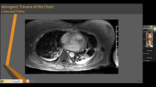 Cardiovascular Magnetic Resonance in Cardiac Iatrogenic Trauma  Leila Rezai Gharai MD [upl. by Ecnal]