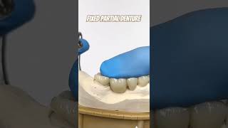 Dental Crown and Bridge 😃👍dentalcrowns indradentalvlogs dentaltreatment shorts [upl. by Lidstone]