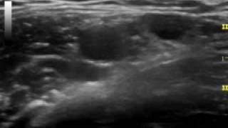 Axillary Ultrasound Anatomy [upl. by Suhploda]