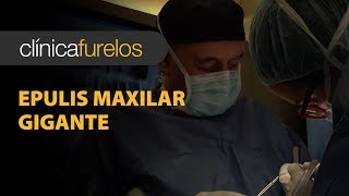 Epulis maxilar gigante [upl. by Elfrieda]