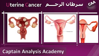 E4 Understanding Endometrial Cancer Uterine cancer سرطان الرحم اسبابة وطرق تشخيصة و علاجه [upl. by Siuoleoj475]