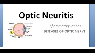 Ophthalmology Optic neuritis Papillitis NeuroRetinitis RetroBulbar phosphenes uhthoff pulfrich [upl. by Nevet905]