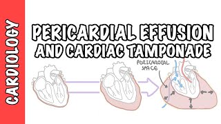 Cardiac Tamponade  pericardial effusion causes pathophysiology investigations and treatment [upl. by Bautram]