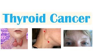 Thyroid Cancer Papillary Follicular Medullary amp Anaplastic  Symptoms Diagnosis Treatment [upl. by Cassiani334]