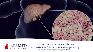 Esteatosis hepática asociada a disfunción metabólica MASLD NAFLD [upl. by Namielus]