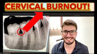 Cervical Burnout or Caries How to Know theories of dental caries in teeth cavity ICDAS x ray [upl. by Ahselrak598]