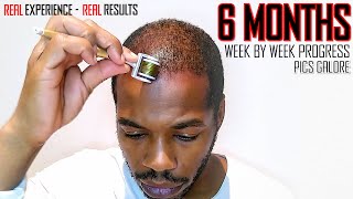 Derma roller Hair Regrowth Results 6 Months  Month by Month Progress  Coffee as a DHT Blocker [upl. by Shari923]