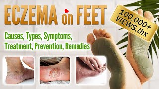 Eczema on foot Causes Symptoms Types Treatment Prevention and Home Remedies  Feet Eczema [upl. by Nela205]