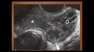 Ultrasonographic diagnosis of Pyosalpinx [upl. by Arbe919]