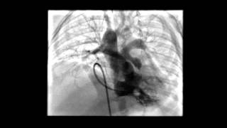 Tetralogy of Fallot RV Angiogram [upl. by Otreblide]