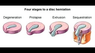 Physiotherapy for Intervertebral Disc prolapse StayHome and study WithMe [upl. by Kachine288]