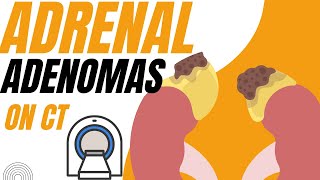 Adrenal adenomas on CT  a diagnostic approach [upl. by Trilley818]