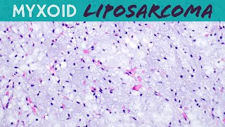 Myxoid Liposarcoma explained in 5 minutes basic soft tissue pathology sarcoma pathologists [upl. by Hanna]