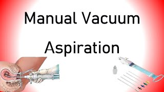 Manual Vacuum Aspiration MVA [upl. by Asiral292]