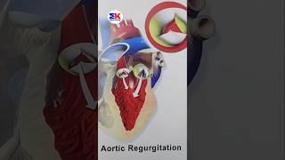 Aortic Regurgitation  shorts medicineknowledgehindi [upl. by Aynotan]