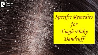 FLAKY SCALP DANDRUFF not cleared by Home Remedies What to do  Dr Amee Daxini  Doctors Circle [upl. by Danella]