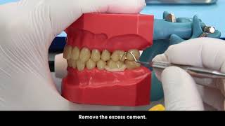 RelyX U 200 cementation on zirconia crown [upl. by Aveline]