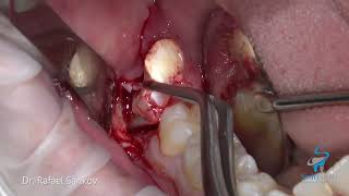 Lower Wisdom Tooth Extraction With Dentin Graft [upl. by Notrem]