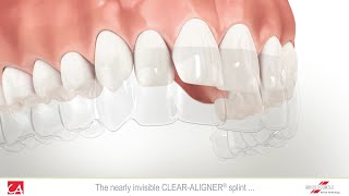 Treatment of Malocclusion Teeth with Invisible Splint [upl. by Nai]