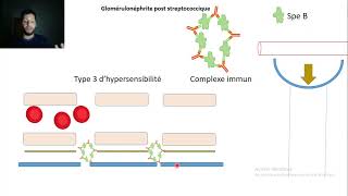 10glomérulonéphrite post streptococcique [upl. by Finlay]