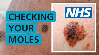 How do I check if my mole is skin cancer  NHS [upl. by Ytinirt]