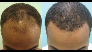 Try This Hair Loss Treatment To Stimulate Hair Regrowth [upl. by Trudi]