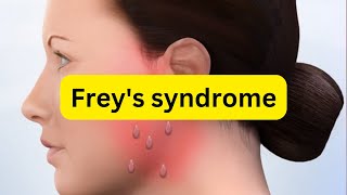 What is freys syndrome [upl. by Delanty]