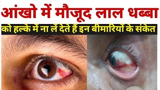 आंख लाल होने का कारण  subconjunctival hemorrhage in hindi  subconjunctival hemorrhage treatment [upl. by Bergmann]