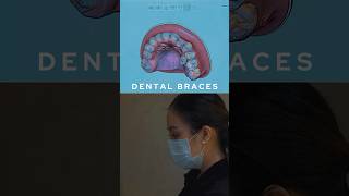 Braces installation process dentist cosmeticprocedure dentalclinic braces dentistry [upl. by Mota]