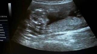 Ultraschall in der 15 SSW Its a Boy [upl. by Sublett542]