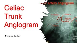 Radiographic Anatomy  Celiac Trunk Angiogram [upl. by Enirak]