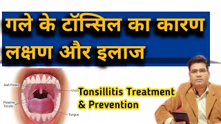 What are Tosillitis Cause Symptoms amp Treatment TONSIL KA ILAJ [upl. by Bonaparte]