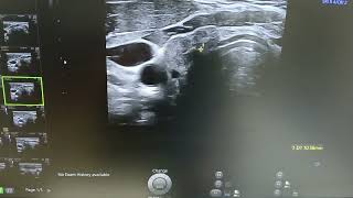 Thyroid atrophy  Hypoplasia  Small Thyroid  Ultrasound [upl. by Bernice]