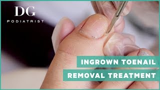 Ingrown toenail removal treatment [upl. by Amitaf193]