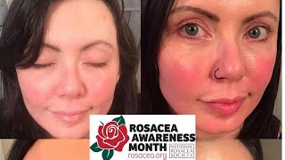 Common triggers of Rosacea foryou [upl. by Aicrop]