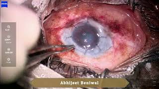 Optical penetrating keratoplasty in Xeroderma Pigmentosum [upl. by Aerdnak559]