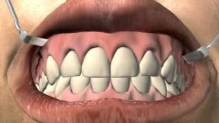 What is a tooth fistula [upl. by Karl39]