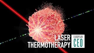 Laser therapy for cancer may promote better immune response  European CEO [upl. by Harihat]